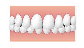上顎前突症(いわゆる「出っ歯」)