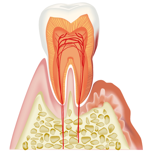 歯周病は知らないうちに徐々に悪化していきます