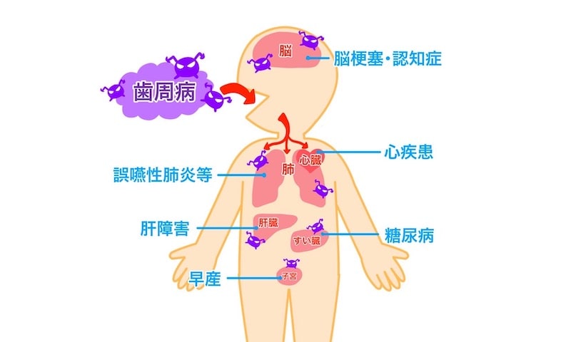 歯周病は口の中の問題だけではありません